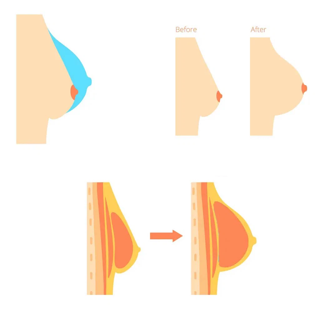 breast enhancement